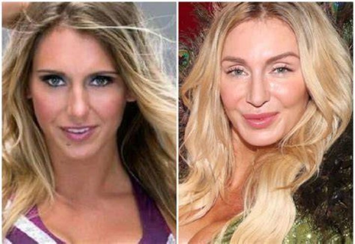 Charlotte Flair Before And After Surgery Pics, Age Wiki And Family |
